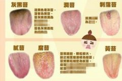正常的舌苔一般是什么颜色?不正常的舌苔预示着什么疾病？